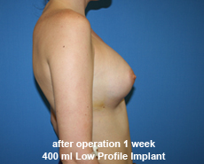 plastic-surgery-breast-augmentation